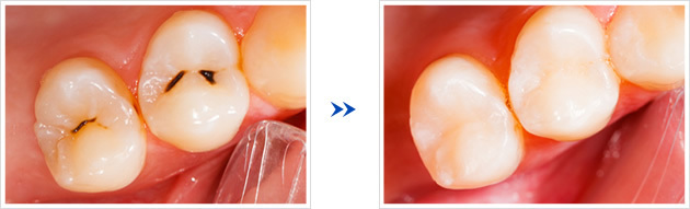 虫歯 自然 治癒 した