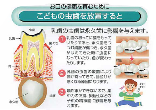乳歯 虫歯 永久歯 へ の 影響