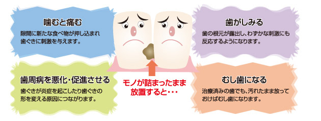 歯に食べ物がはさまる 詰まる時の治療ーノーブルデンタルクリニック仙台 仙台駅東口 日曜診療 夜間診療
