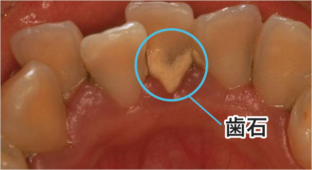 歯石とは何ですか?