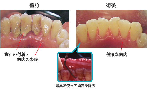 歯石取り