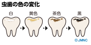 虫歯の色の変化 茶色い点 ーノーブルデンタルクリニック仙台 仙台駅東口 日曜診療 夜間診療