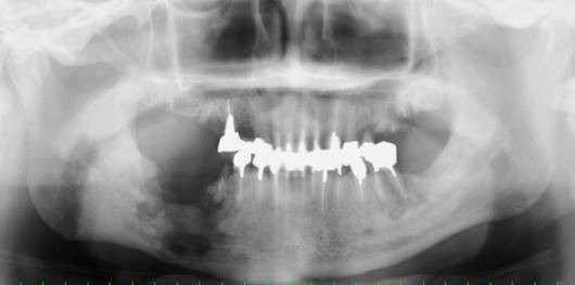 炎 顎骨 骨髄 歯周辺の激痛「顎骨骨髄炎（がっこつこつずいえん）」 [歯・口の病気]