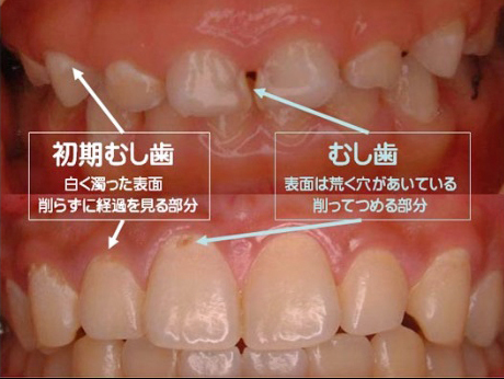 虫歯治療 白い点 ーノーブルデンタルクリニック仙台 仙台駅東口 日曜診療 夜間診療