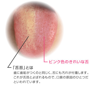 舌苔と口臭についてーノーブルデンタルクリニック仙台 仙台駅東口 日曜診療 夜間診療