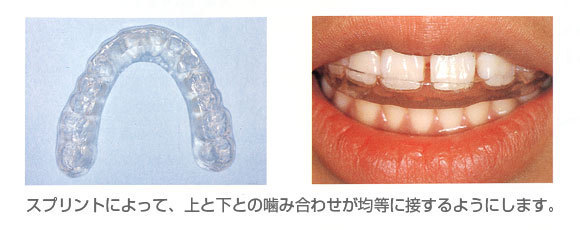 スプリント マウスピース のしくみ