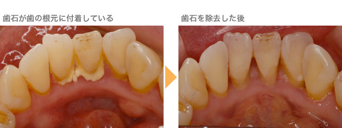 歯石 取り 後 噛む と 痛い