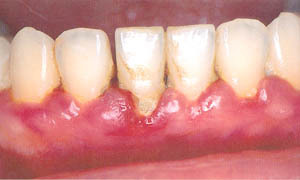歯茎 から 血 が 出る