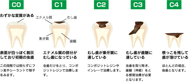 虫歯治療の治療回数(通院回数)ーノーブルデンタルクリニック仙台(仙台 