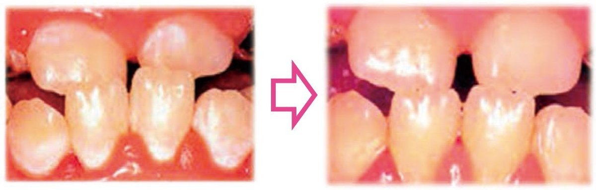 虫歯 歯磨き 治っ た