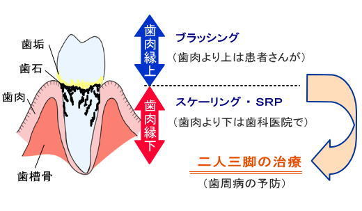 歯周病の治し方 治療法 ーノーブルデンタルクリニック仙台 仙台駅東口 日曜診療 夜間診療 歯周病の治し方 治療法 ーノーブルデンタルクリニック仙台 仙台駅東口 日曜診療 夜間診療