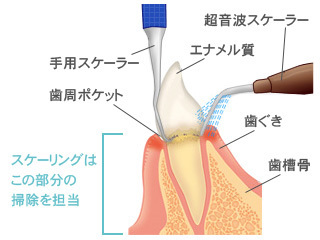 歯石取りスケラー