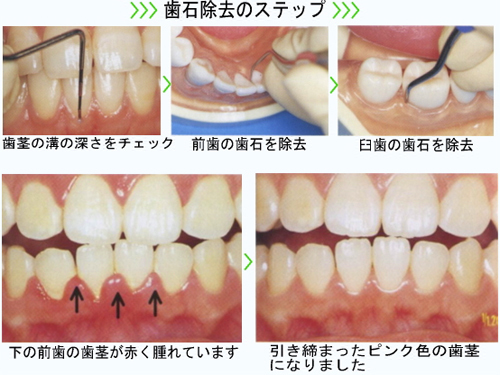 歯石取り