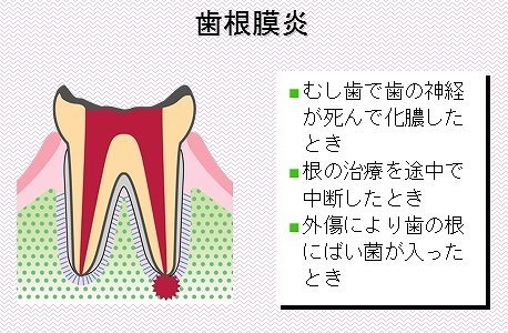 て 痛い 歯 が 浮い