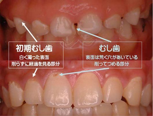 歯 と 歯 の 間 虫歯 初期