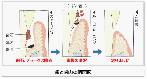 歯科 srp とは