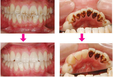 歯 の ヤニ 取り