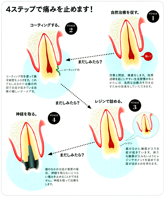 知覚 過敏 治す に は