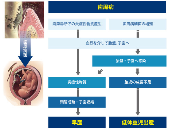 妊娠性歯周炎と早産・低体重児出産の関係ーノーブルデンタルクリニック仙台(仙台駅東口・日曜診療・夜間診療)