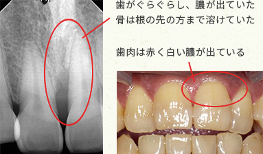 歯ぐきが腫れて膿が出た時の治療ーノーブルデンタルクリニック仙台 仙台駅東口 日曜診療 夜間診療