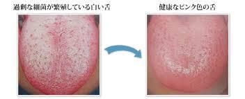 舌苔と口臭についてーノーブルデンタルクリニック仙台 仙台駅東口 日曜診療 夜間診療