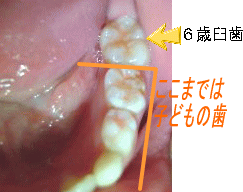 ６才臼歯の虫歯予防