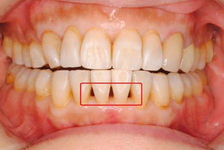 歯周病と歯ぐきの隙間(ブラックトライアングル)ーノーブルデンタル
