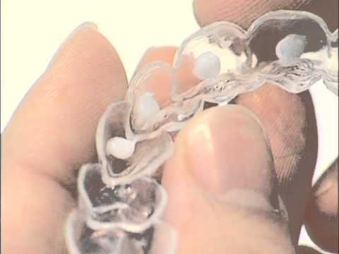 ホームホワイトニングのやり方(方法)ーノーブルデンタルクリニック仙台