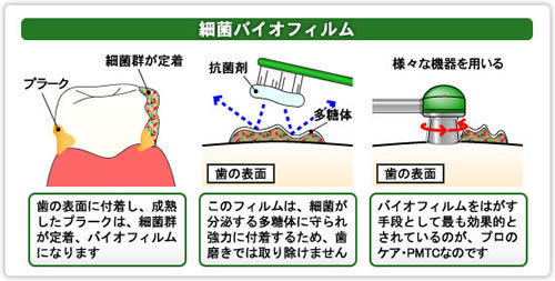 バイオフィルムの除去-ノーブルデンタルクリニック仙台