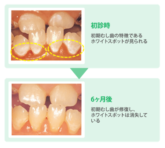 なるべく削らない虫歯治療 - ノーブルデンタルクリニック仙台